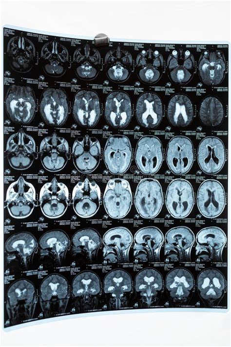 La Imagen De Resonancia Magnética Del Cerebro O De La Exploración De La