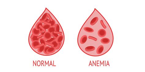 Morphological Classification Of Anemia The Blood Project Hot Sex Picture