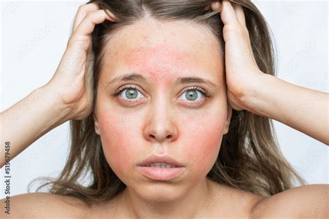 A Young Caucasian Worried Woman With A Red Allergic Rash On Her Cheeks