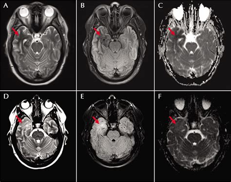 JLE Epileptic Disorders Location Atypical Lesions In Non Ketotic