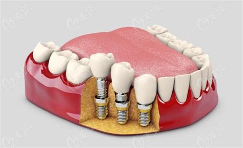乐山种植牙多少钱一颗公布乐山单颗半口全口种植牙收费标准最热整形行业新闻话题 美佳网