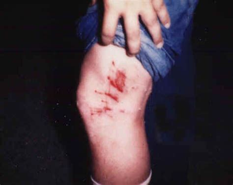 Inferencing With Pictures What Do You Think Caused This Injury What