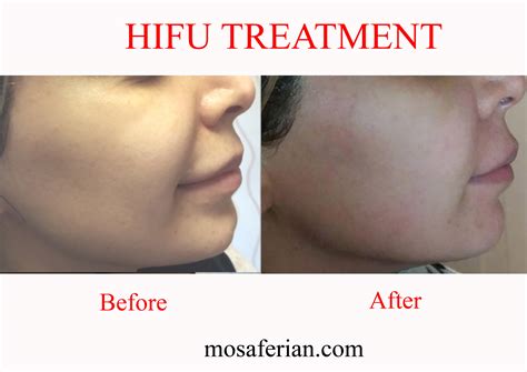 hifu face treatment 11