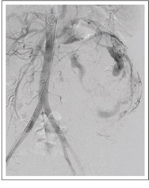 Figure 2 From Management Of Expanding Giant Renal Angiomyolipoma In