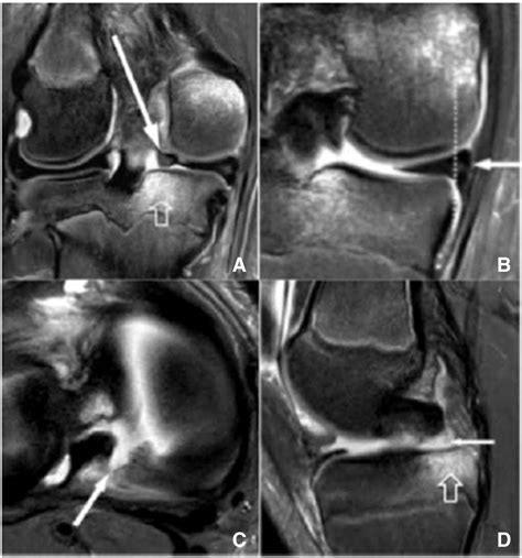 Root Avulsion Of The Posterior Horn Of The Medial Meniscus In Skeletally Immature Patients The