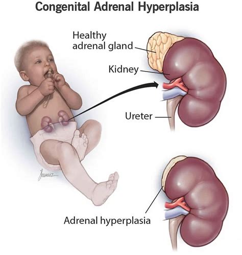 Congenital Adrenal Hyperplasia Causes Signs Symptoms Diagnosis