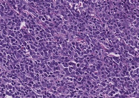 Testicular Cd5 Negative Mantle Cell Lymphoma With Blastoid And Pleomorphic Features By Siba El