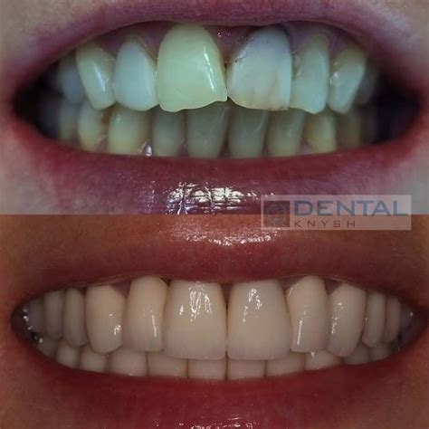 Вініри Львів | Вініри ціна Львів | Стоматологія DentalKnysh