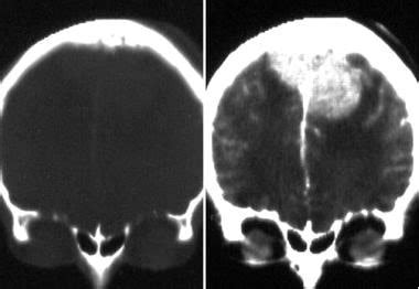 Brain Meningioma Imaging Overview Radiography Computed Tomography