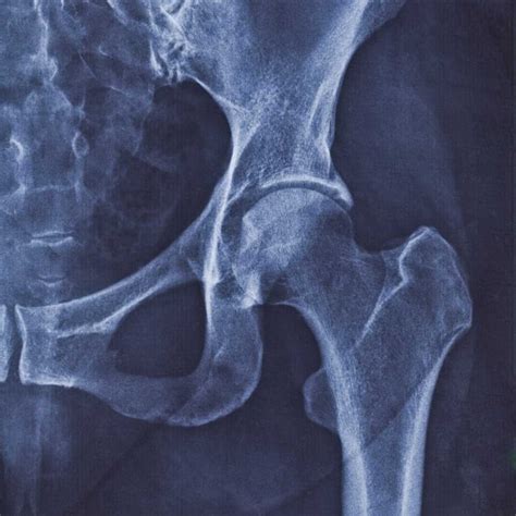 Coxarthrose Hüftarthrose Beschwerden Behandlung