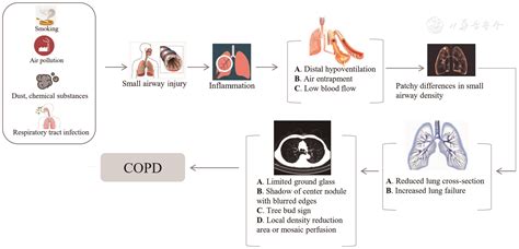 Computed Tomography Identified Phenotypes Of Small Airway Obstructions