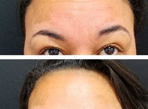 Antes E Depois Preenchimento De Rugas E Linhas De Express O Botox