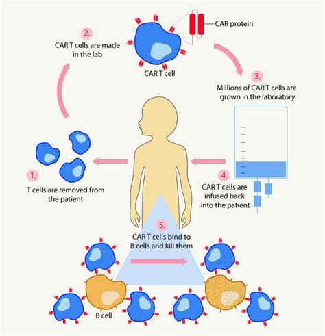 What Is Lupus And Can Car T Cell Therapy Help Treat It Fromtbot