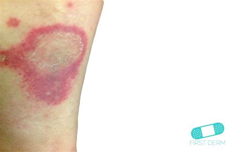 Online Dermatology Vasculitis Leukocytoclastic Vasculitis
