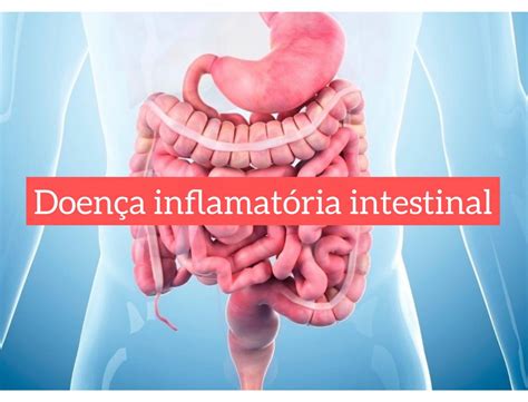 Doença Inflamatória Intestinal Samia Keller Luccas