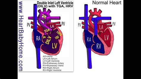 32 Double Inlet Left Ventricle With Hrv And Pulmonary Stenosis Youtube