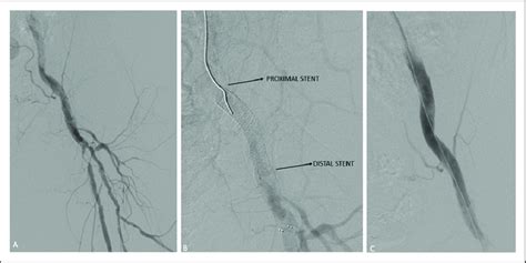 Single Stent Isolated Common Femoral Artery Initial Angiogram