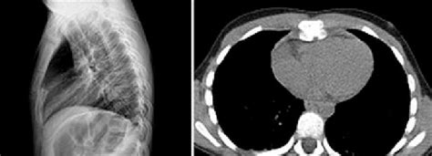 A Displaced Sternum On Lateral Chest X Ray B Computed Tomography