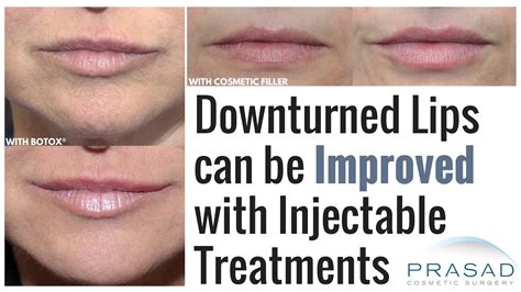 How To Fix Downturned Lips Lipstutorial Org