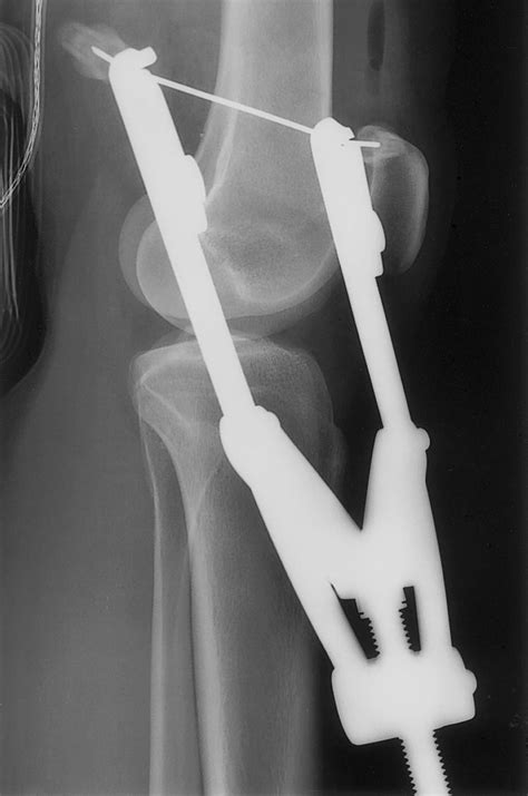 External Traction Device Lateral Radiograph Of The Knee Shows A