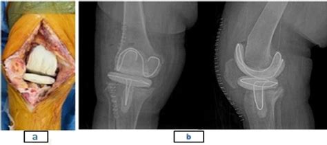 a, the knee after insertion of the spacer. b, AP and lateral ...