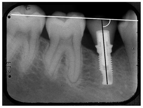 Jcm Free Full Text Influence Of Crown Implant Ratio And Implant Inclination On Marginal Bone