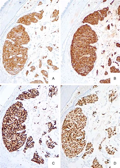 Immunohistochemical Staining Patterns Of The Neuroendocrine Subtype Of