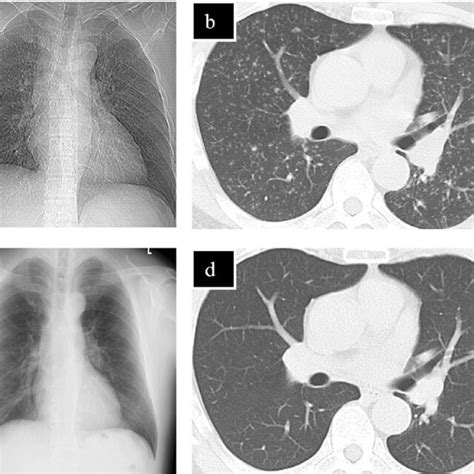 Chest X Ray And Ct Before And After Treatment For Miliary Tb Chest Download Scientific Diagram