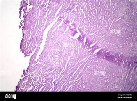 Photomicrograph Of Aortic Atherosclerosis Revealing Plaque Buildup And