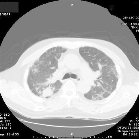 Ct Chest Of The Patient Shows Right Upper Lobe Mass And Bilateral