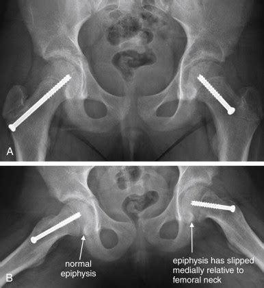 Pelvic Fracture X Ray