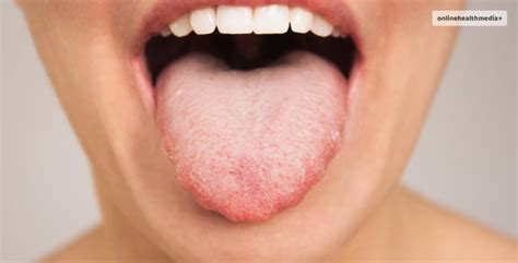 Transient Lingual Papillitis How To Know If You Have This