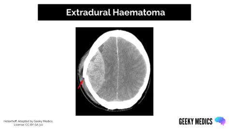 Types Of Intracranial Haemorrhage Bleeds Geeky Medics