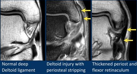 Medial Ankle Ligaments Mri