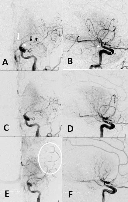 Intracranial Arterial Dissection Neuroangio Org