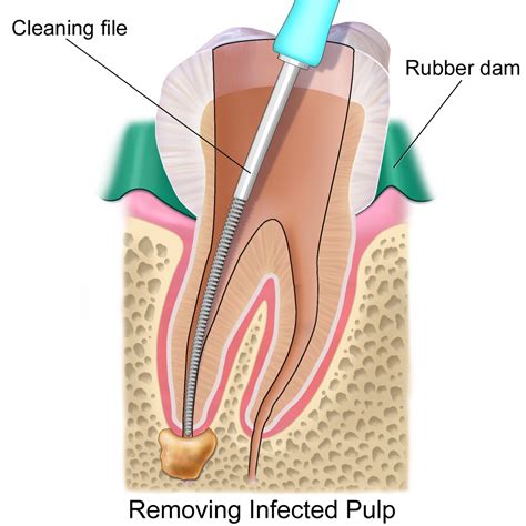 Root Canal Treatment Wikipedia