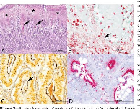 Necrotizing Enterocolitis Histology