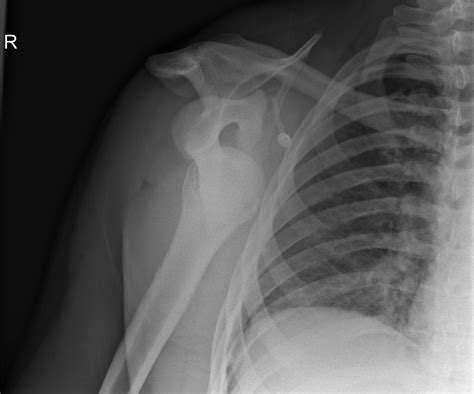 Anterior Shoulder Dislocation Image