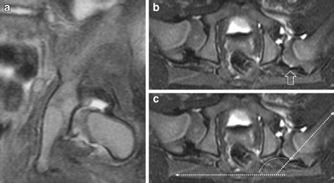 Imaging Of Developmental Dysplasia Of The Hip Ultrasound Radiography And Magnetic Resonance