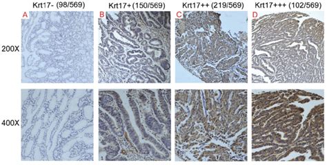 Krt Expression In Gc Tissue Samples A D Representive Images Of