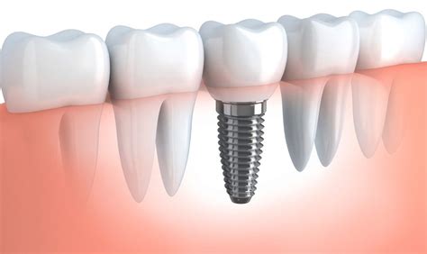 Overseas Dental Implants The Risks Dr Paulo Pinho