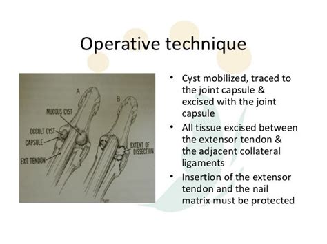 Mucous Cysts Dip Jw