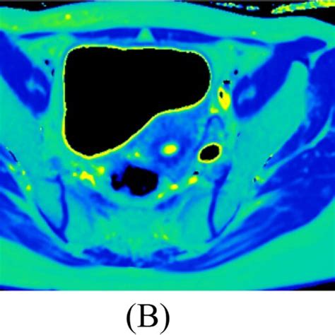 Pelvis Axial T2 Weighted Image A And T2 Maps Under 1 5 T B And 3 0 T