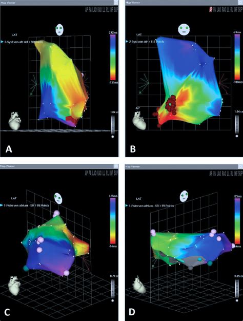 Carto Tm Activation Maps Of Systemic Venous Atrium A And B And