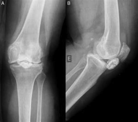 A radiografias AP B radiografia em perfil de tumoração do