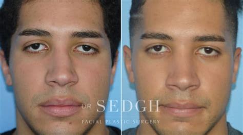 Crooked Nose Surgery Before And After Photos Dr Sedgh