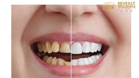 Invisalign Before And After Beverly Wilshire Dental