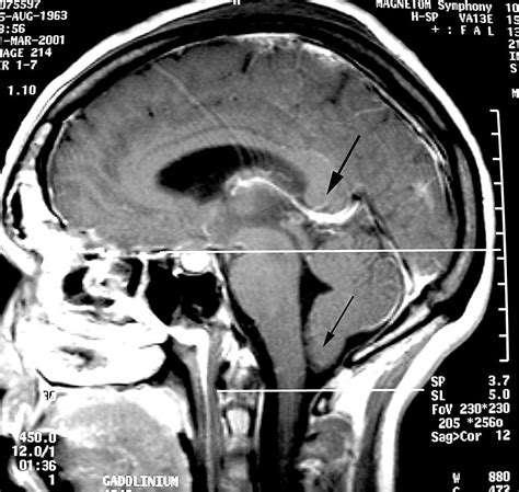 Brain herniation