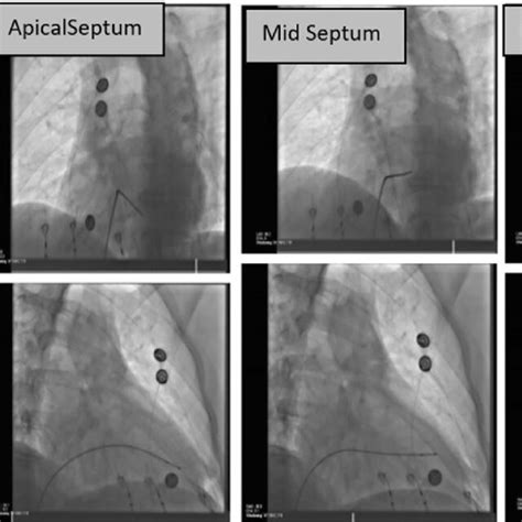 Fluoroscopic Images In The Left Anterior Oblique Top Row And Right