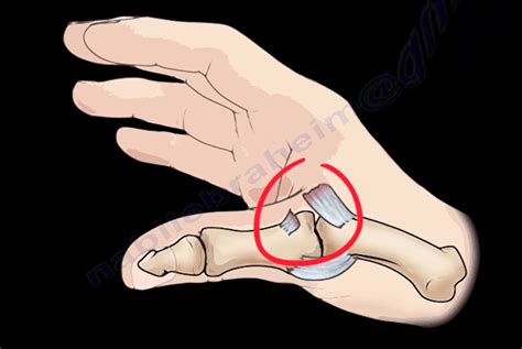 Ulnar Collateral Ligament Injury Of Thumb Orthopaedicprinciples